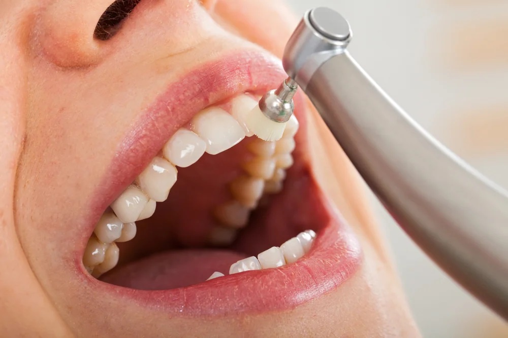 Fluoride therapy