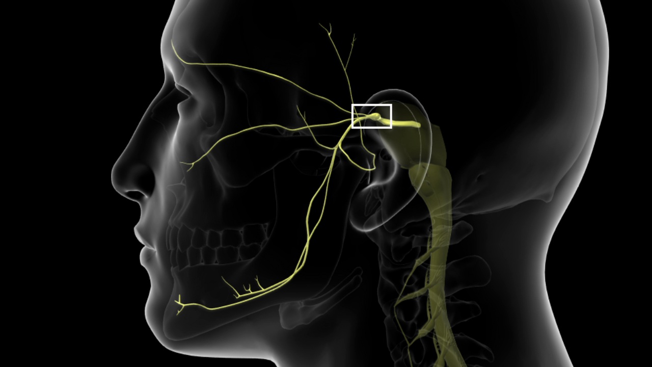 Trigeminal nerve and implants