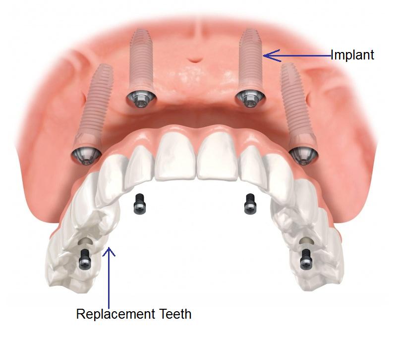Number of implants suitable for the jaw