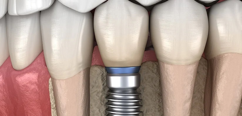 importance of the nerve in implants