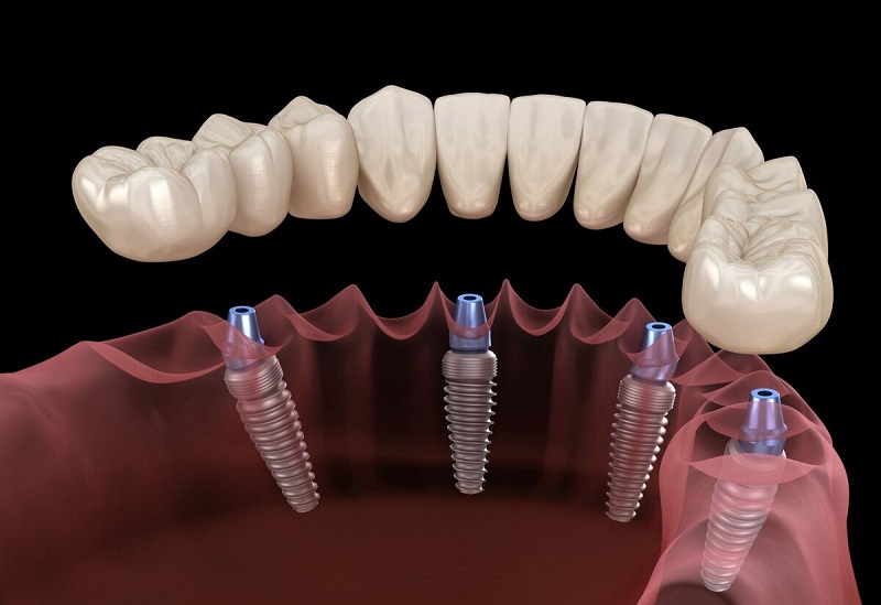 Number of implants suitable for the jaw