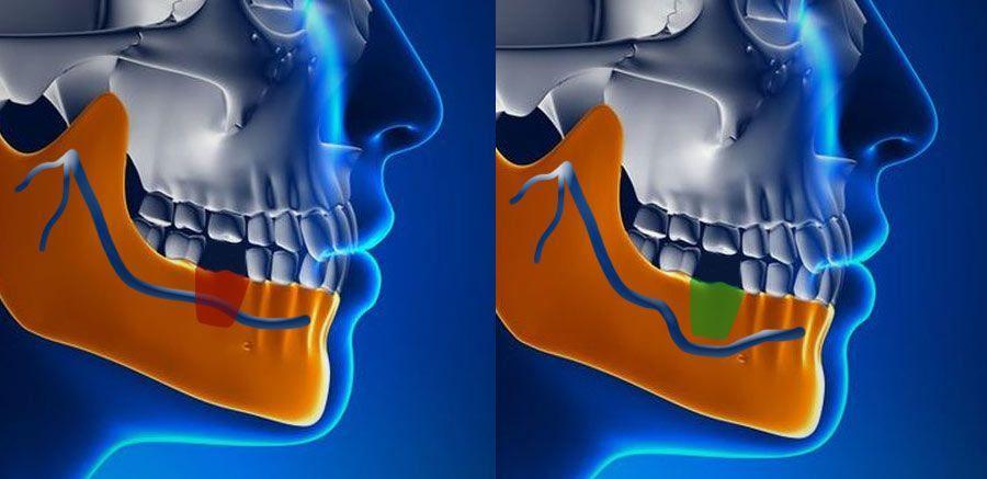 importance of the nerve in implants