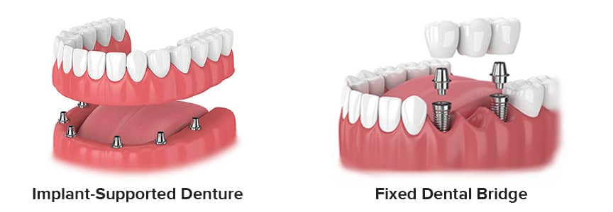 Number of implants suitable for the jaw