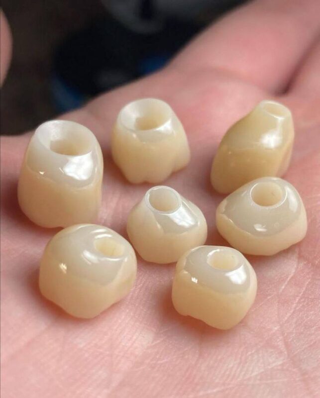 implant-veneer