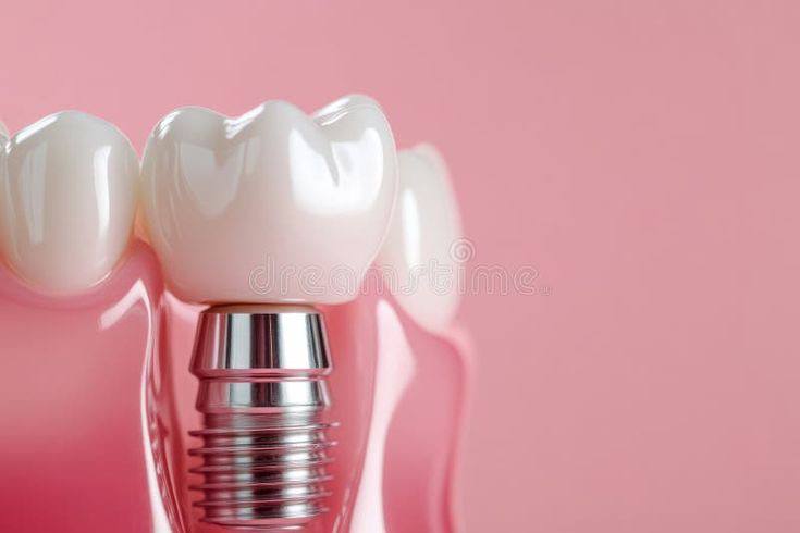 implant-veneer