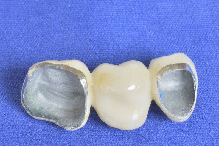 implant-veneer