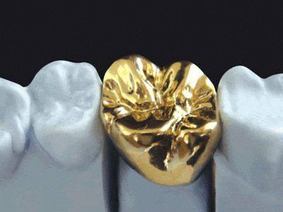 implant-veneer