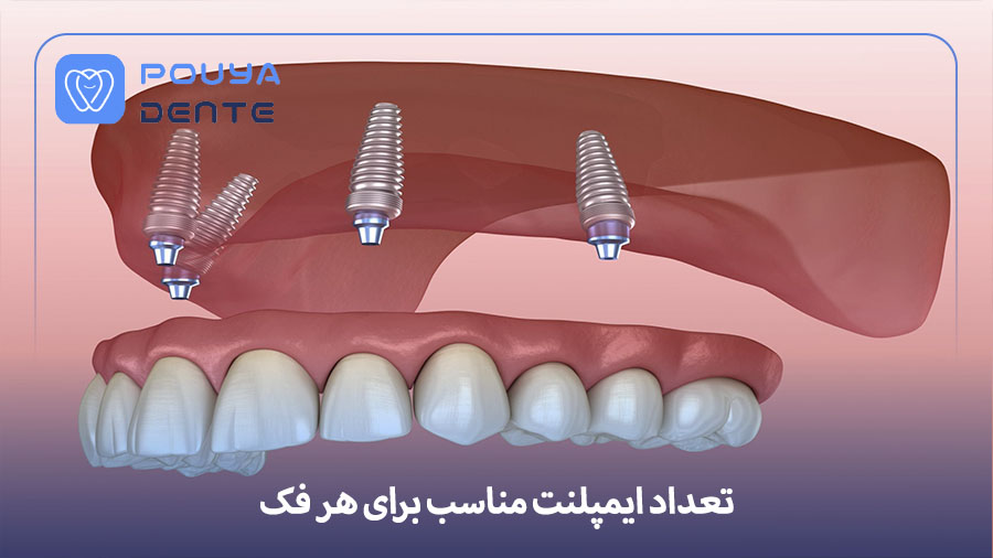 Number of implants suitable for the jaw