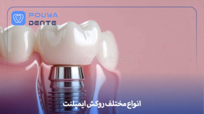 implant-veneer