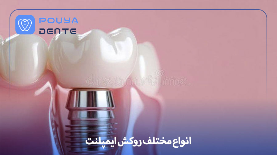 implant-veneer