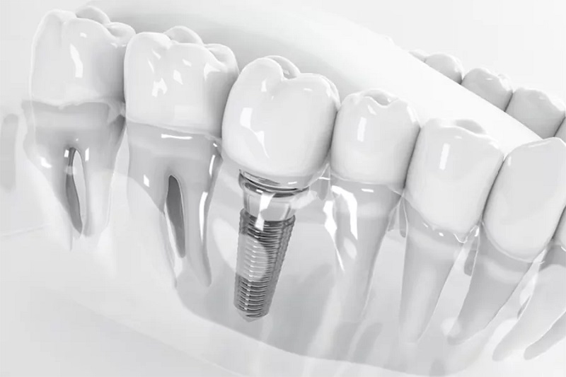 Implant molding