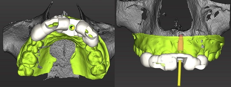anterior-and-posterior-implants