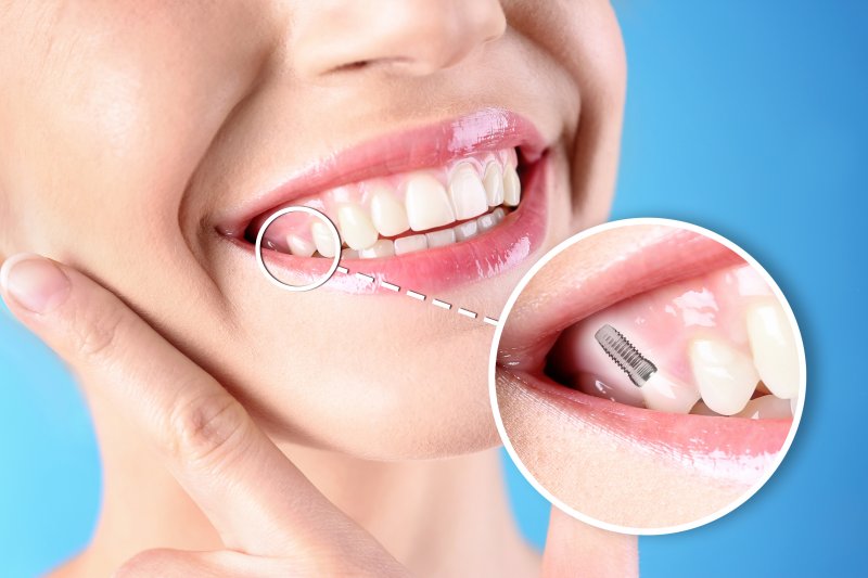 anterior-and-posterior-implants