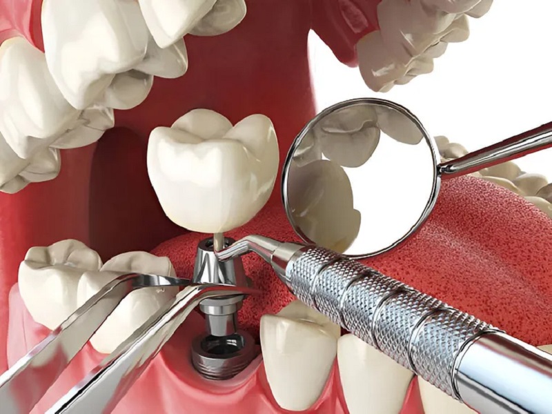 anterior-and-posterior-implants