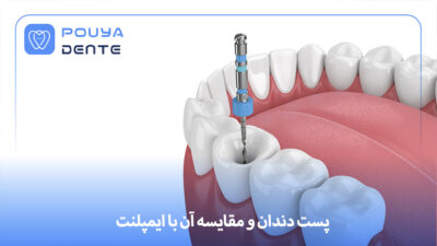dental post vs implant