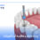 dental post vs implant