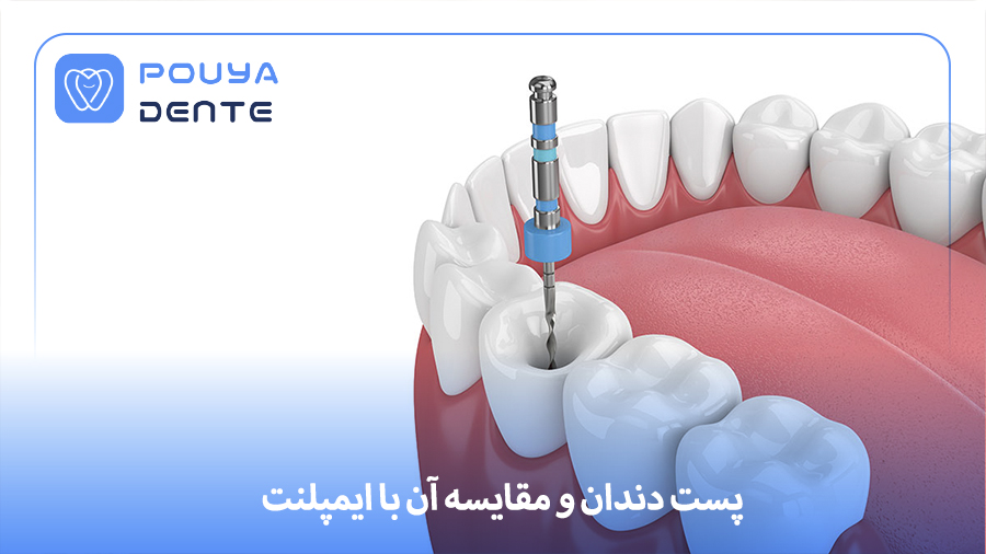dental post vs implant
