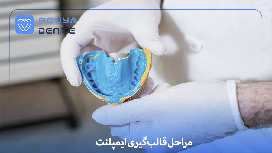 implant impressions