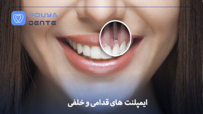 anterior-and-posterior-implants