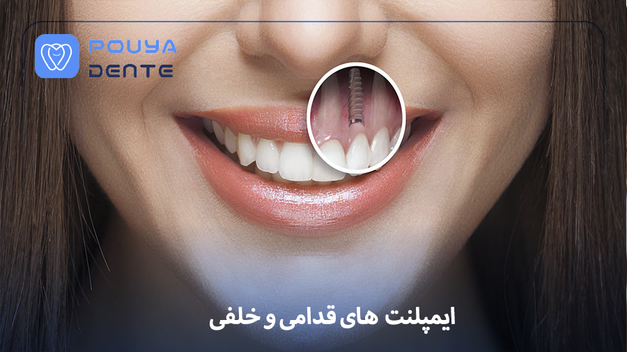 anterior-and-posterior-implants