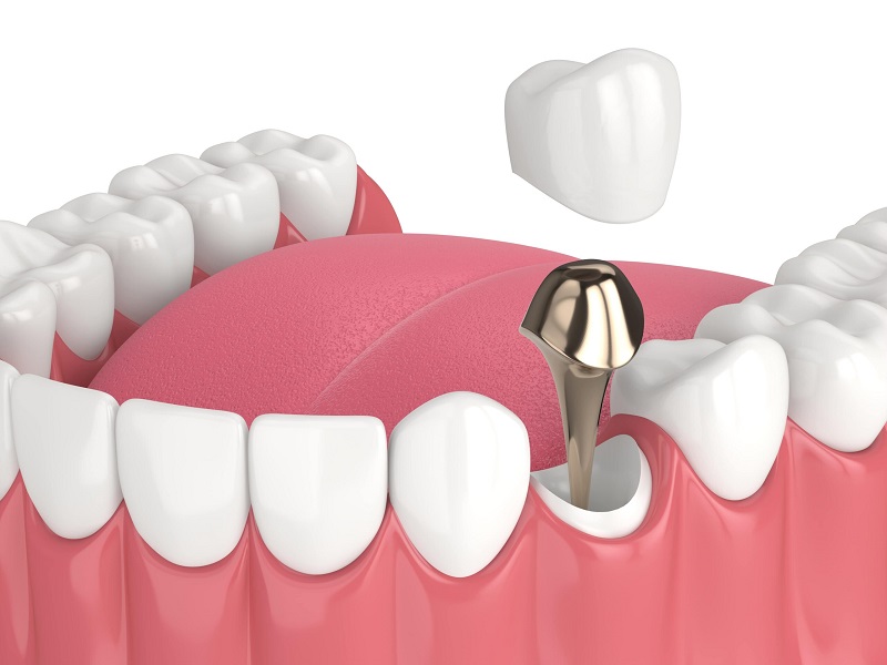dental post vs implant