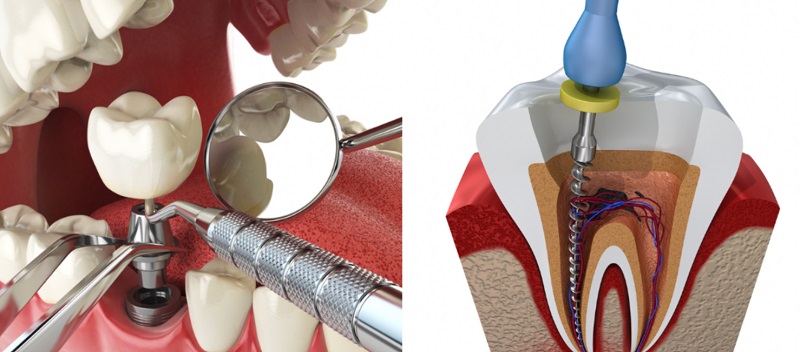 dental post vs implant