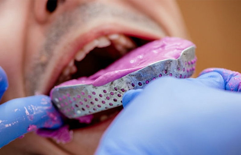 Implant molding