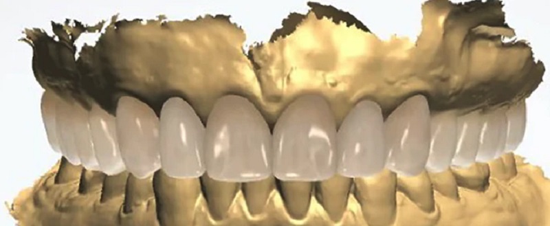 dental-wax-up