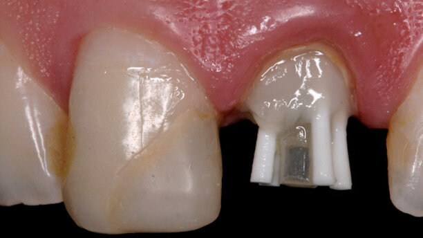 Dental pin