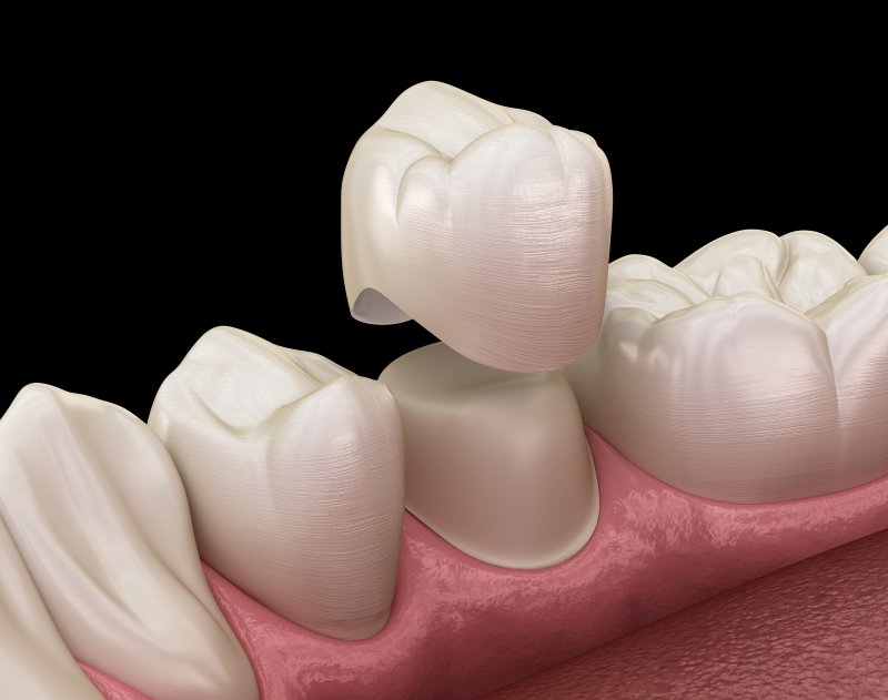 preparing-teeth-for-crowns