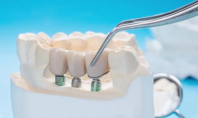 preparing-teeth-for-crowns