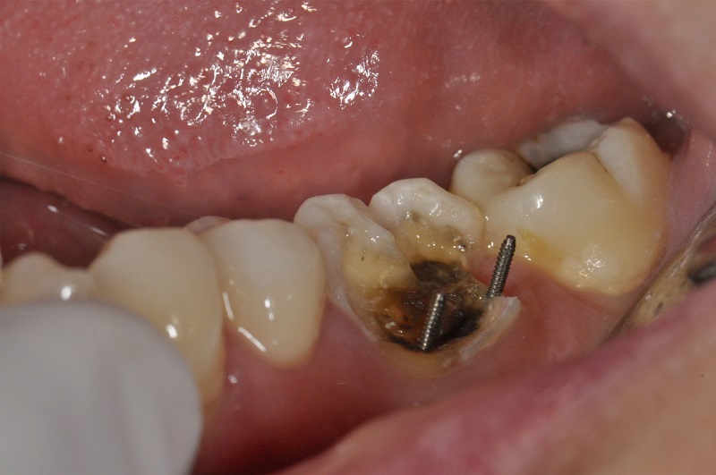 Dental pin