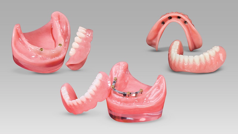 Implant-supported overdenture