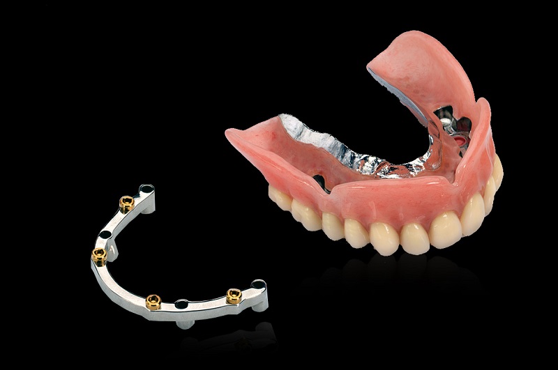 Implant-supported overdenture