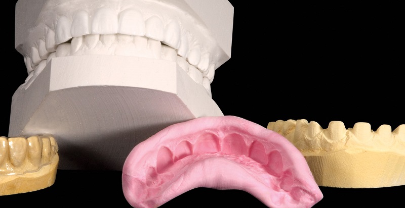 dental-wax-up