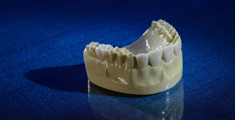 dental-wax-up