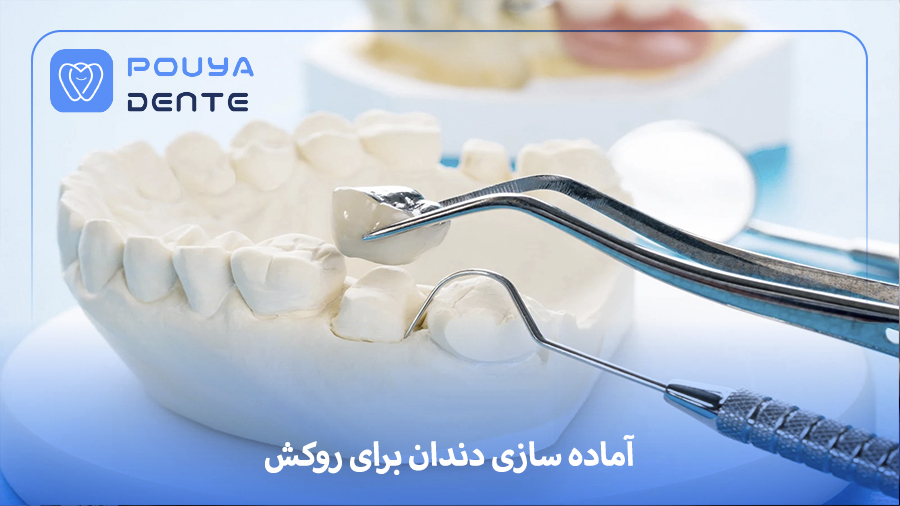 preparing-teeth-for-crowns