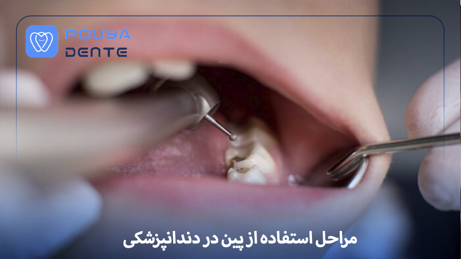 Dental pin