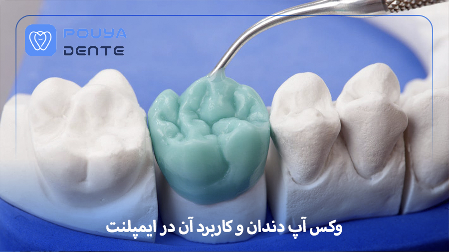 dental-wax-up