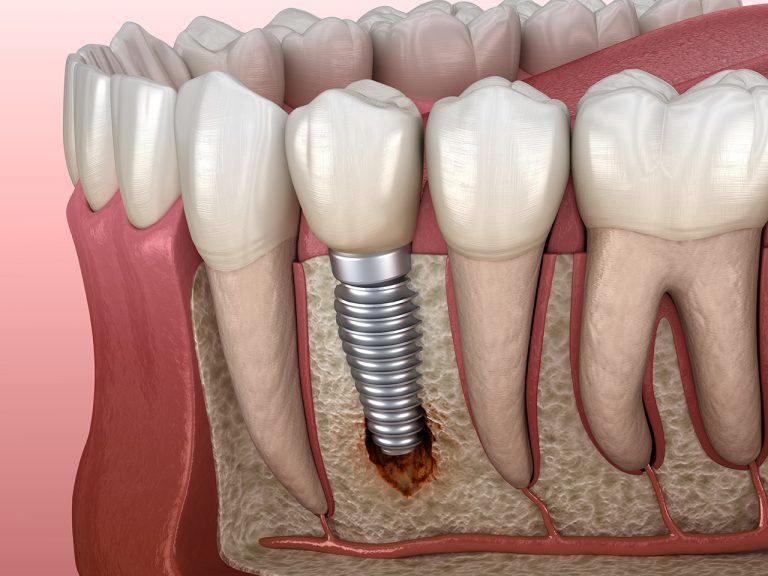 implant-infection