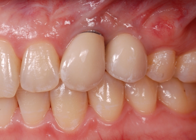 Blackening of gums after implants