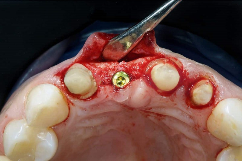 implant-infection