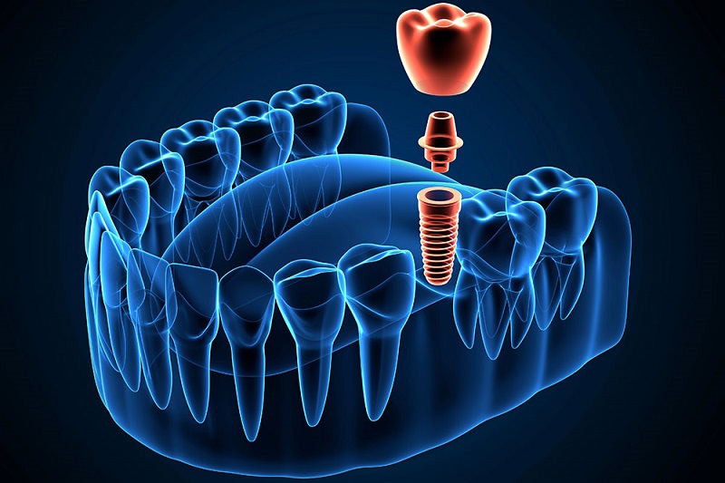 digital-implant