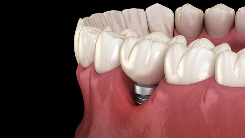 Blackening of gums after implants