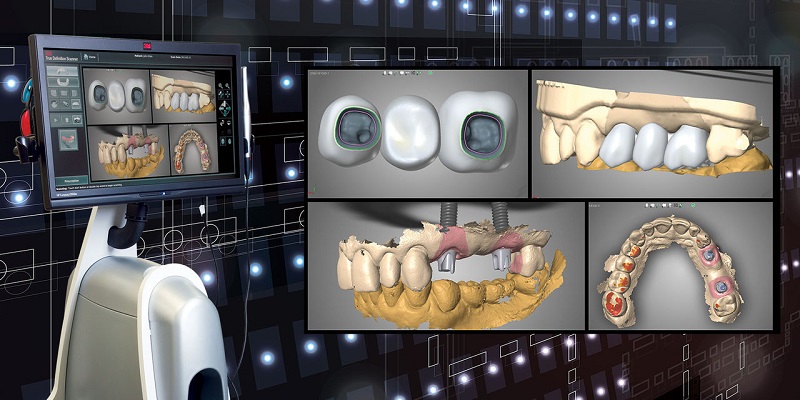 digital-implant