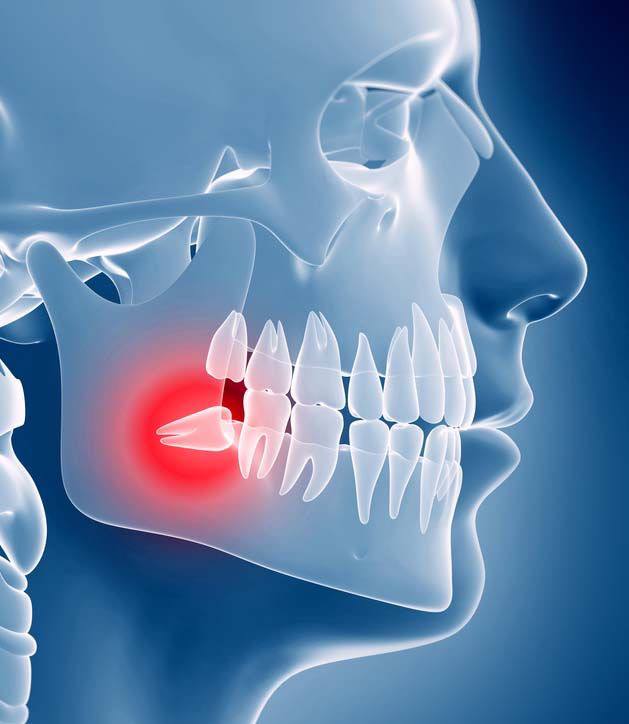 Wisdom tooth implant