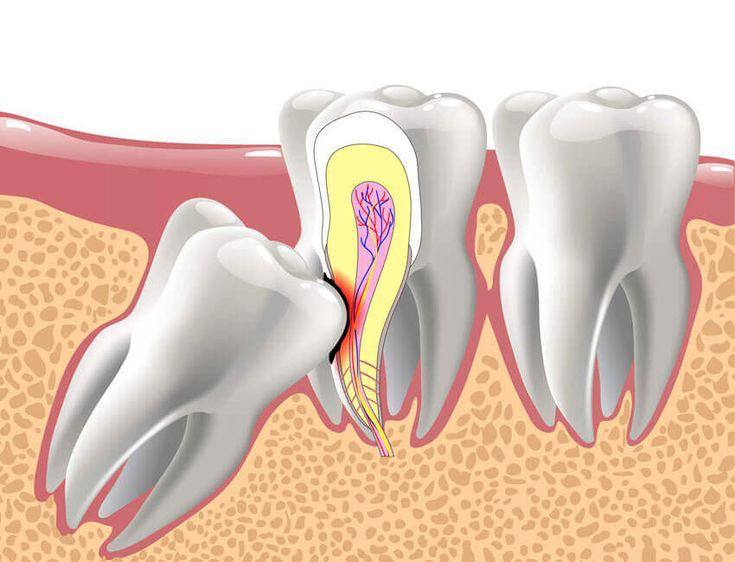 Wisdom tooth implant