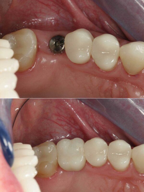 dental Implant for children