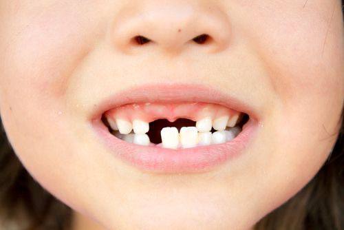 dental Implant for children