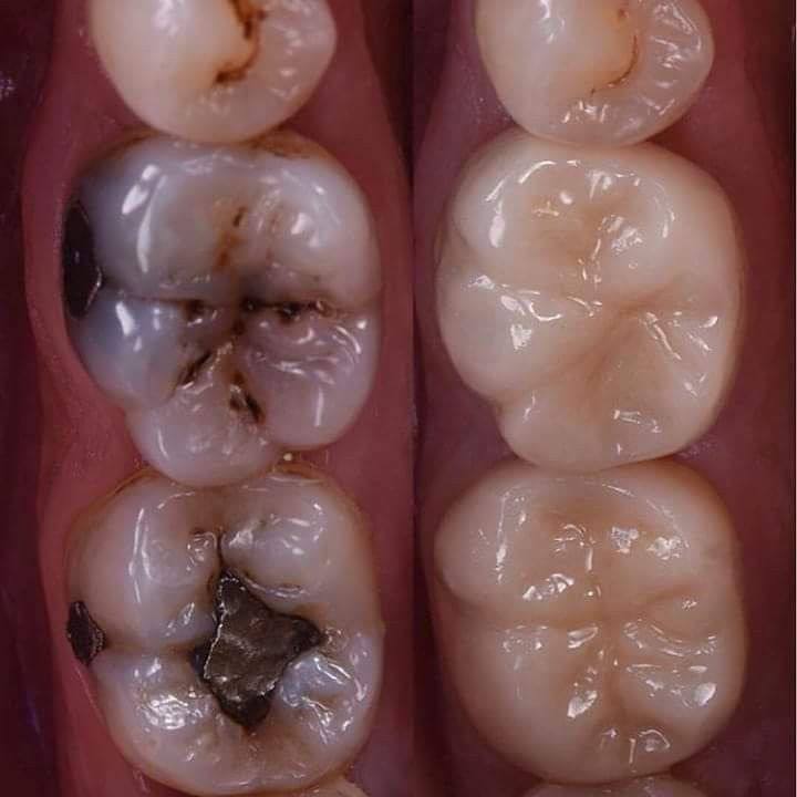 Blackening of gums after implants